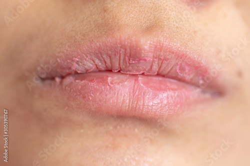 Backgrounds of Dry lips in the clinic.