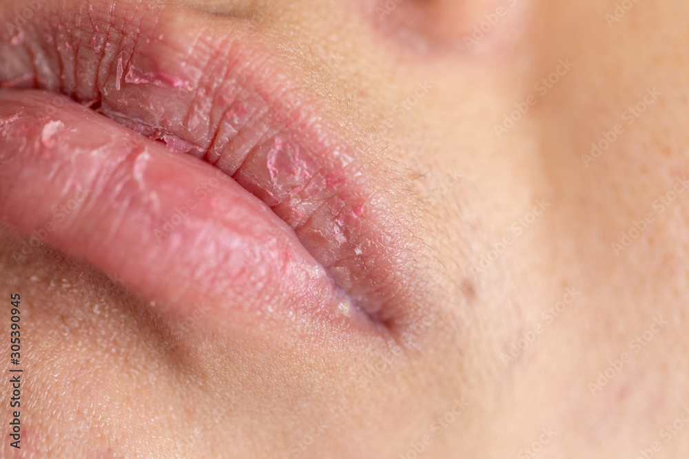 Backgrounds of Dry lips in the clinic. Backgrounds of Dry lips in the clinic.