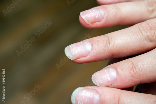 vitamin deficiency avitaminosis anemia nail problem with white dots