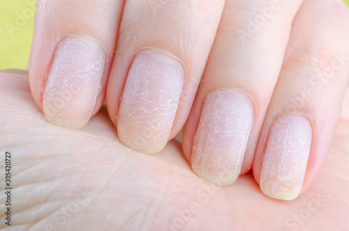 damaged nails after removing modern gel nail polish