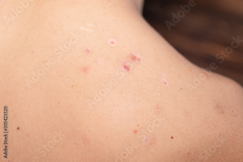 Teenager's skin with pimples, blackheads and moles. Dermatological problem of skin diseases