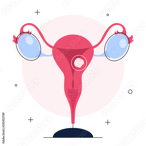 Ovarian cancer diagnostic. Idea of health and medical treatment.