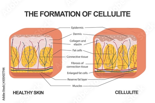 The formation of cellulite. Cellulite occurs in most females and rarely in males. Vector diagram. Comparative illustration of normal skin and cellulite s skin. photo