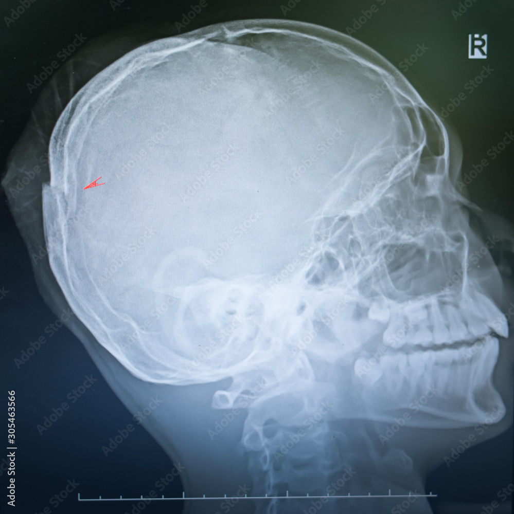 x ray film of a skull of a patient suffering from traumatic injury