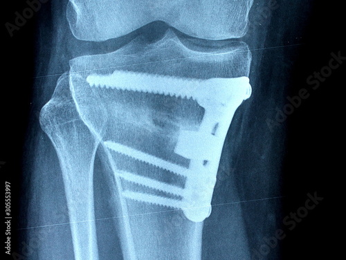 osteotomy photo