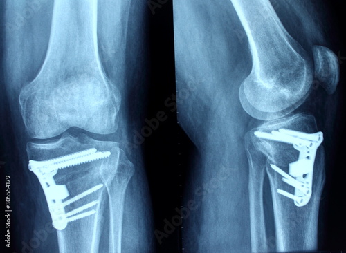Φωτογραφία osteotomy