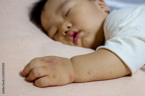 Hand Foot and Mouth disease photo