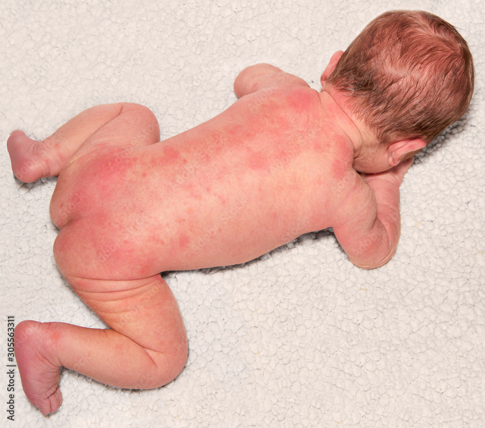 Newborn with baby acne on the body possibly from an adverse