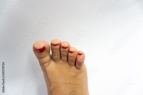 Huge water foot corn on a pinky toe at woman led, close up of a callus, isolated on white background. Cosmetology concept.