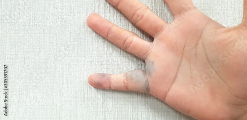 Man's hand has varicose veins in his right finger and swollen or inflamed isolated on white wallpaper wall. Body of human part and Healthcare or therapy concept.