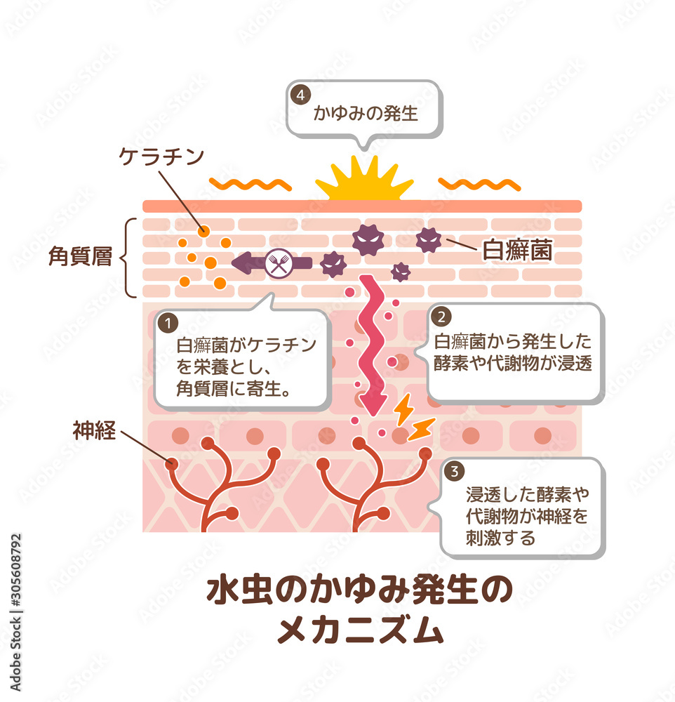 水虫のかゆみ発生のメカニズム 皮膚断面図 図解イラスト 解説付き Stock ベクター Adobe Stock