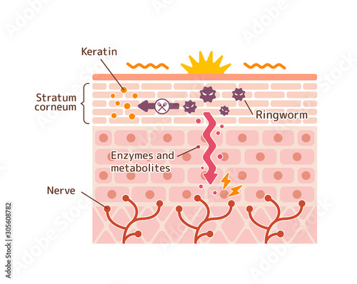 Generation mechanisim of athlete's foot ( ringworm) vector illustration 