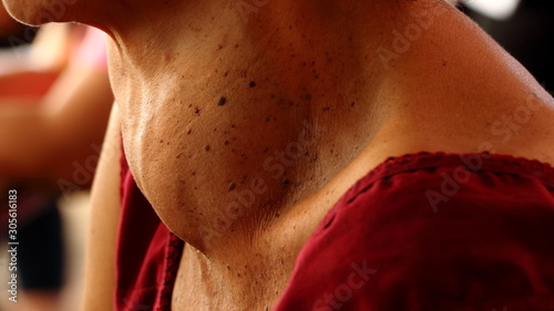 Thai woman patient have abnormal enlargement of thyroid gland Hyperthyroidism at the throat