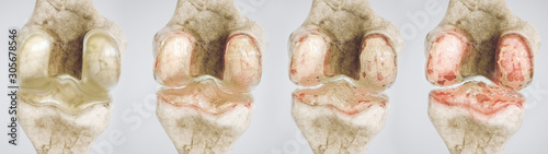 osteoarthritis of the knee in four stages - high degree of detail - 3D Rendering photo
