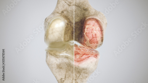 healthy knee and osteoarthritis knee in comparison - high degree of detail - 3D Rendering