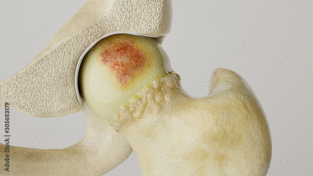Stronger artheritis on the hip joint - high degree of detail - 3D Rendering - obrazy, fototapety, plakaty 