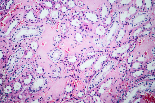 Histopathology of hypertensive renal disease, light micrograph, photo under microscope