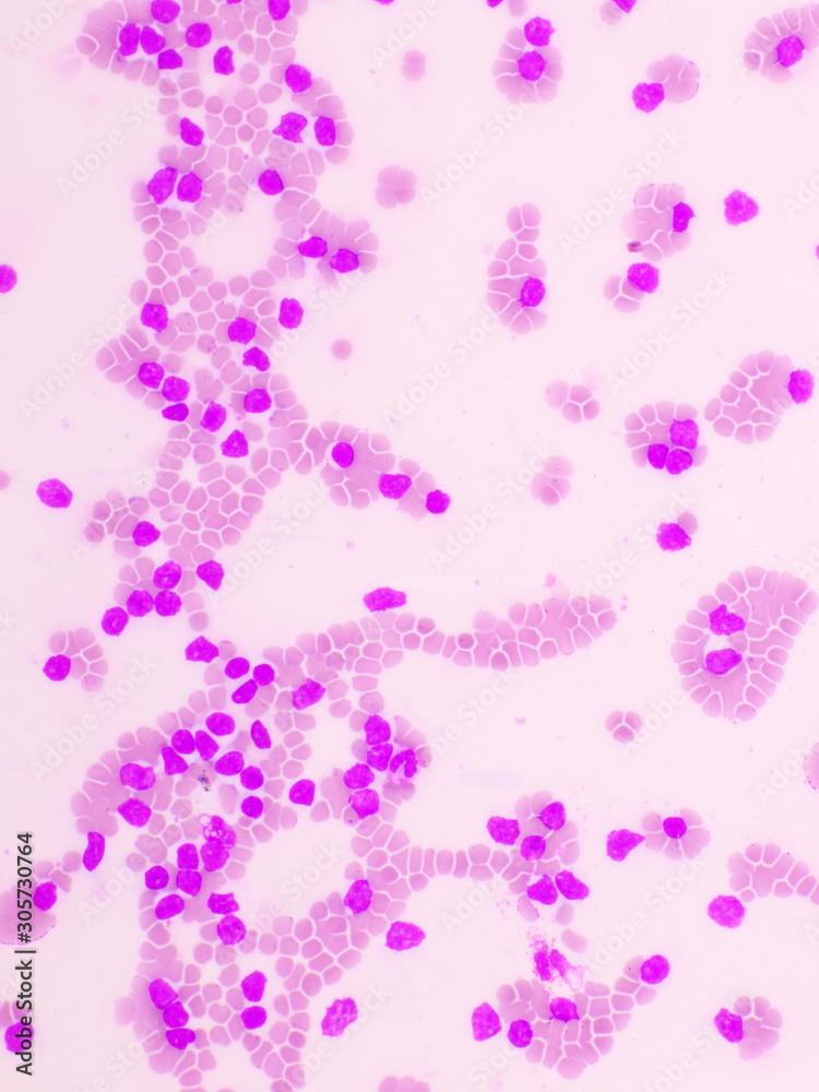 Picture of acute lymphocytic leukemia or ALL cells in blood smear, analyze by microscope, 400x