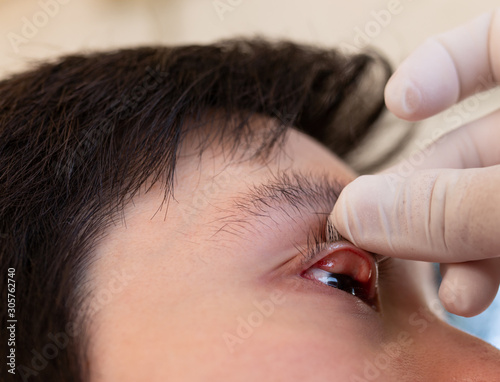 doctor use hand screening conjunctivitis patient, asian patient has red eyes and feeling pain, infection eye 