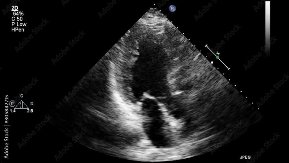 High-quality video ultrasound transesophageal examination of the heart.