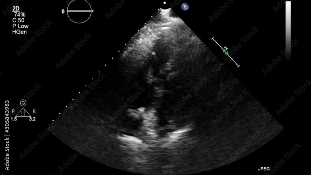 High-quality video ultrasound transesophageal examination of the heart.