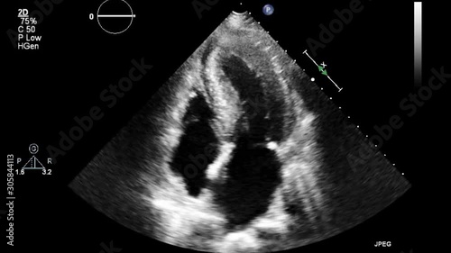 High-quality video ultrasound transesophageal examination of the heart.