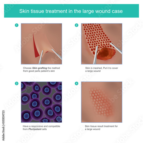 Skin tissue treatment in the large wound. Example illustration explain skin grafting tissue method treatment for large wound.