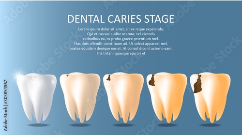 Dental caries stages vector medical poster banner template