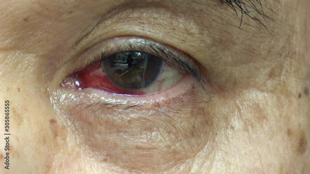 Red Bloodshot Eye With A Incised Wound From Cataract Surgery Eye With red-bloodshot-eye-with-a-incised-wound-from-cataract-surgery-eye-with