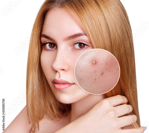 Young blond woman with zoom circle before and after acne treatment.
