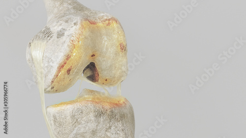 stronger arthritis - stage 2 - on the knee joint - high degree of detail - 3D Rendering photo