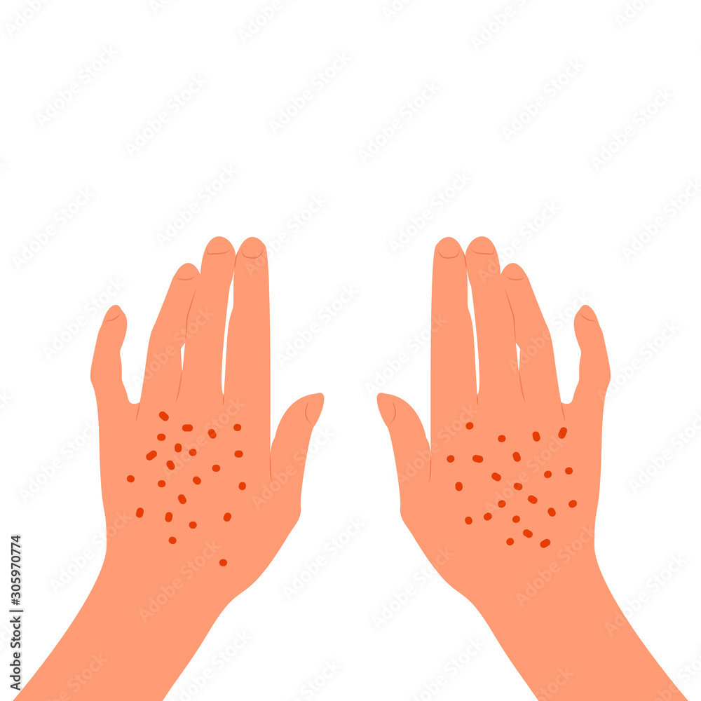 Red rash on the back of the female hands. Skin illness, allergy, inflammation. Isolated on white background. Flat style stock vector. Red rash on the back of the female hands. Skin illness, allergy, inflammation. Isolated on white background. Flat style stock vector.