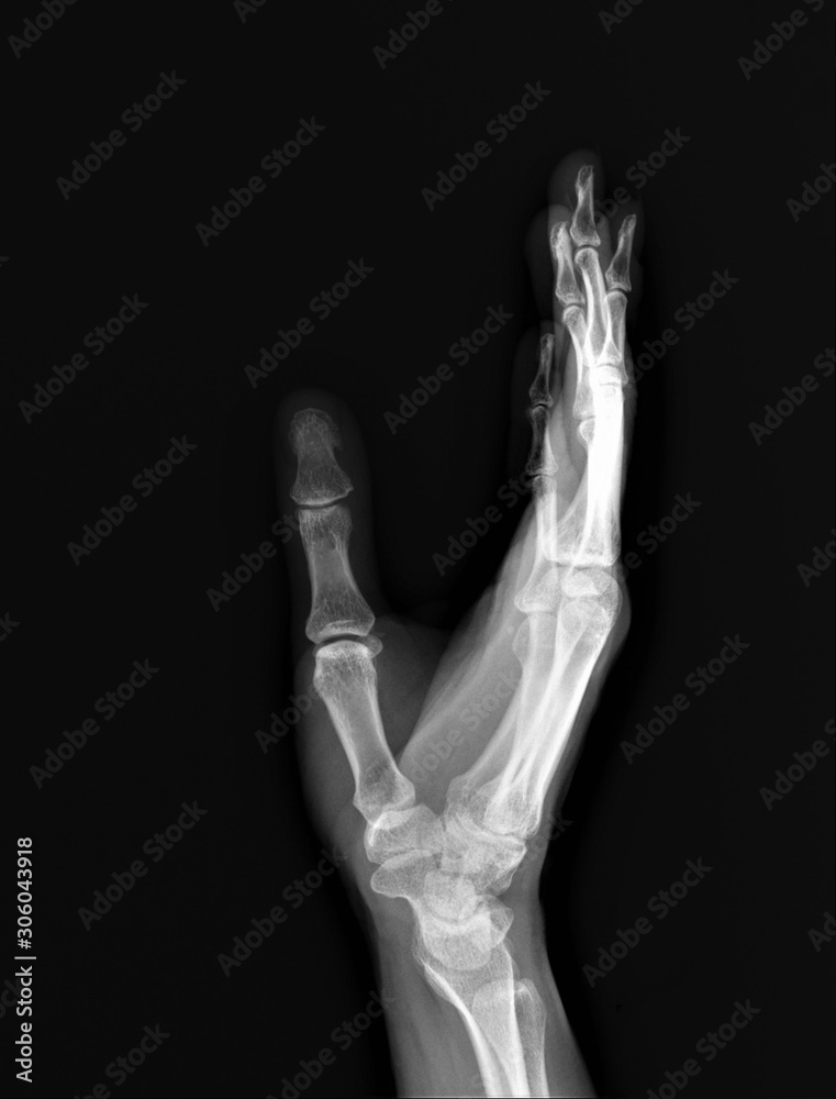 normal x-ray of the hand bones and fingers,orthopedics, medical diagnostics, rheumatology normal x-ray of the hand bones and fingers,orthopedics, medical diagnostics, rheumatology