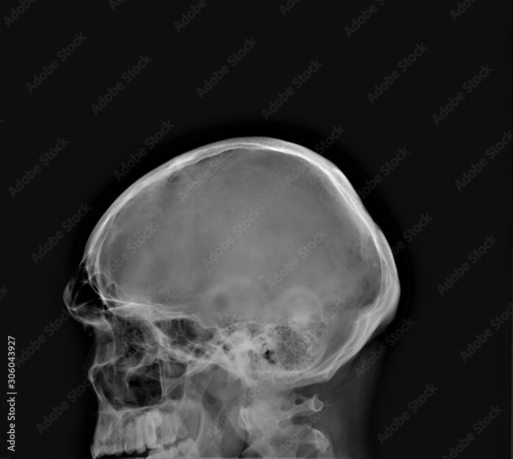 normal radiography of the skull in lateral projection in yellow medical diagnostics, traumatology and orthopedics, neurosurgery normal radiography of the skull in lateral projection in yellow medical diagnostics, traumatology and orthopedics, neurosurgery