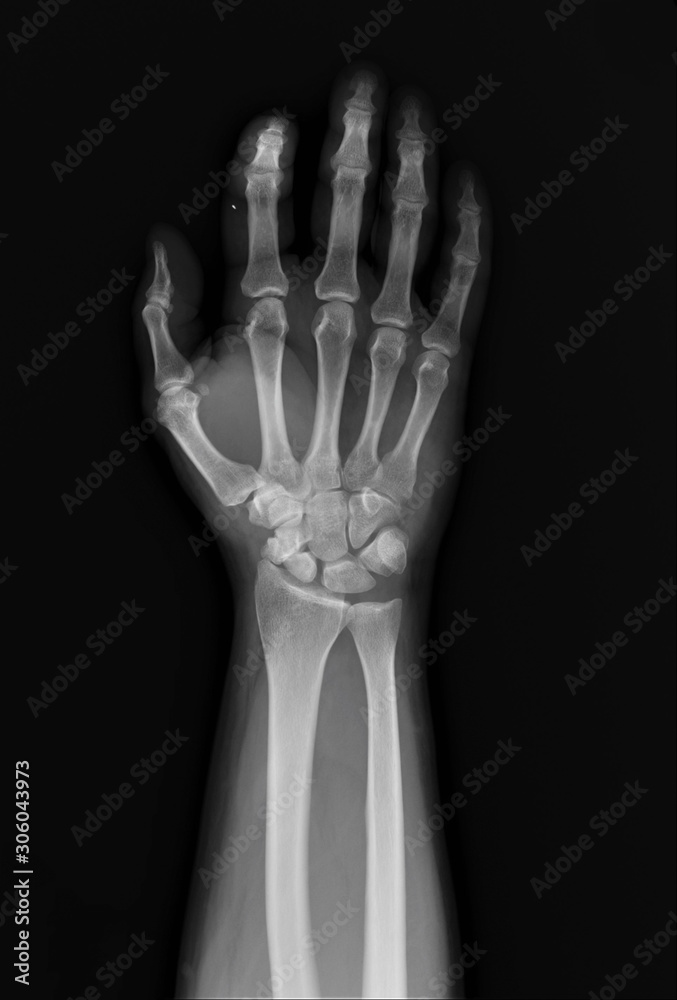 normal x-ray of the hand bones and fingers,orthopedics, medical diagnostics, rheumatology normal x-ray of the hand bones and fingers,orthopedics, medical diagnostics, rheumatology