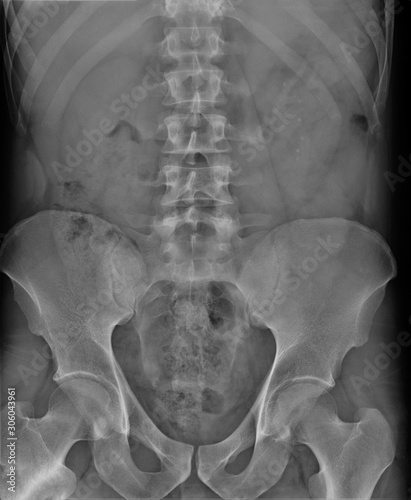 radiography of lumbar and sacral spine, pelvis, coxarthrosis, medical diagnostics