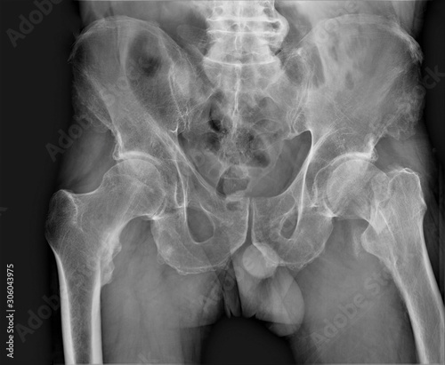 radiography of lumbar and sacral spine, pelvis, coxarthrosis, medical diagnostics