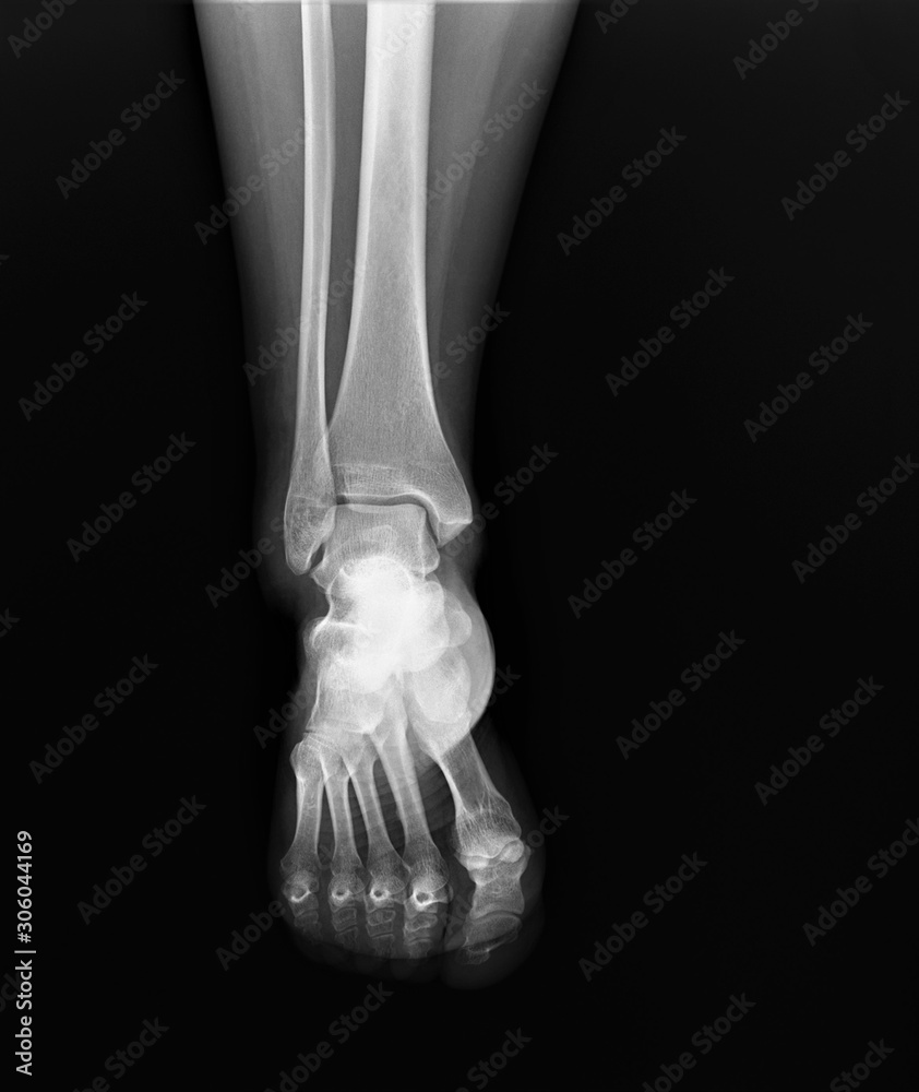 normal radiograph of the ankle joint in front projection,osteoarthritis osteoporosis normal radiograph of the ankle joint in front projection,osteoarthritis osteoporosis