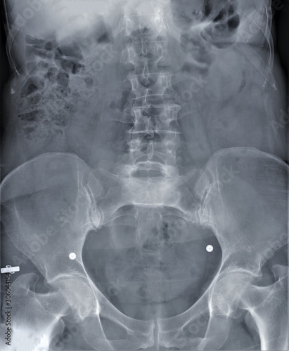 radiography of lumbar and sacral spine, pelvis, coxarthrosis, medical diagnostics photo