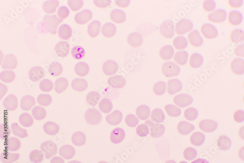 Malaria parasite in red blood cells, ring form stage of Plasmodium falciparum, original magnification 1000x