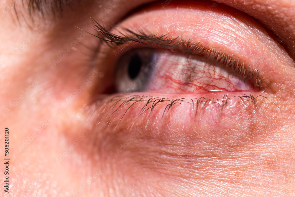 Obraz premium Red capillaries of an inflamed eye near