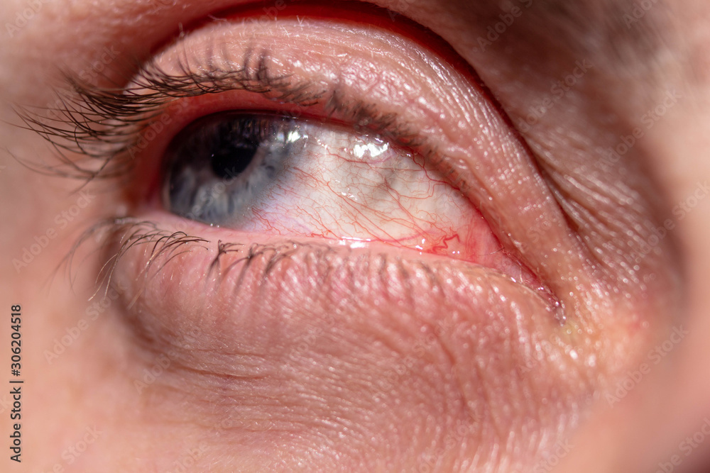 Obraz premium Red capillaries of an inflamed eye near
