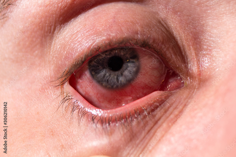 An eyelid is pulled out from a sick eye with inflamed veins from
