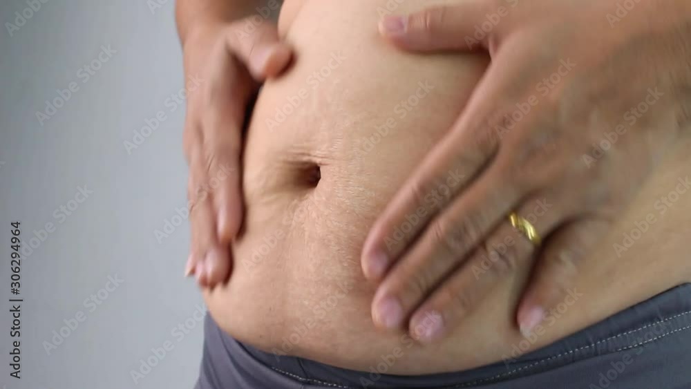 Close up of Woman touching belly skin with stretch marks and loose skin after giving birth. Health care for skin and body shape concept. Close up of Woman touching belly skin with stretch marks and loose skin after giving birth. Health care for skin and body shape concept.