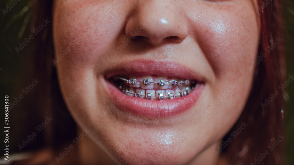 Fototapeta premium Dentistry concept. Smiling brunette girl with braces in her mouth.