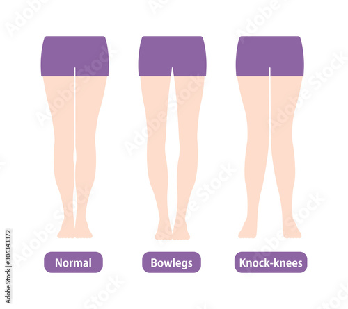 Difference types of  legs angles and knees vector illustration . Normal, Bowlegs, Knock-knees.