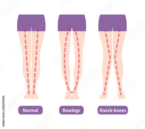 Difference types of  legs angles and knees vector illustration . Normal, Bowlegs, Knock-knees.