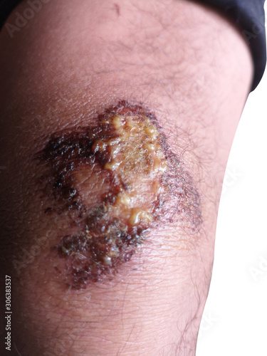 Knee Purulent wound, Inflammation