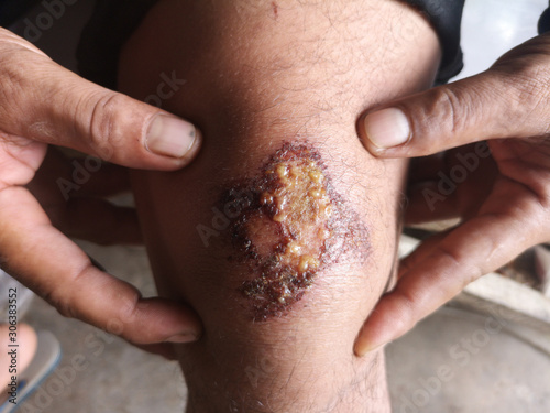 Knee Purulent wound, Inflammation Handle with 2 hands