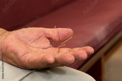 Therapy of man hand with pricking acupuncture needles